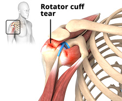 What are the Causes of Rotator Cuff Tears?