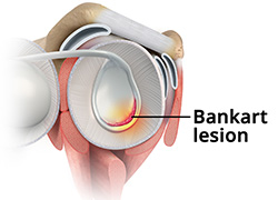 What is a Bankart Tear?