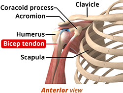What is a Biceps Tendon Rupture?