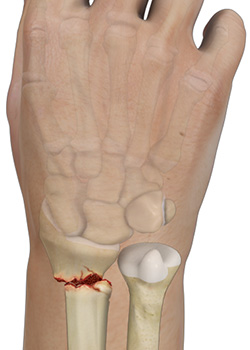 What is a Distal Radius Fracture?