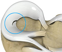 What is a Meniscal Tear