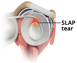 What is a SLAP Tear?