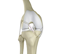 What is ACL Reconstruction?