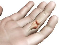 What is Arthritis of the Fingers?
