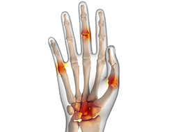 What is Arthritis of the Hand and Wrist?
