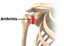 What is Arthritis of the Shoulder?