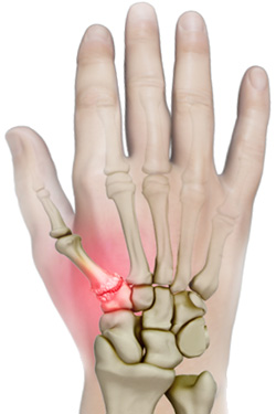 What is Arthritis of the Thumb?