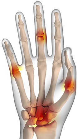 What is Arthritis?