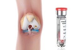 Autologous Chondrocyte Implantation