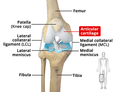 Cartilage Repair