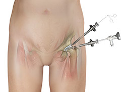 What is Hip Arthroscopy