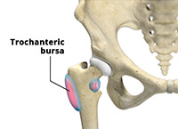 Hip Bursitis