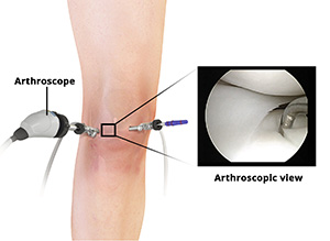 Knee Arthroscopy