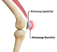 What is Kneecap Bursitis