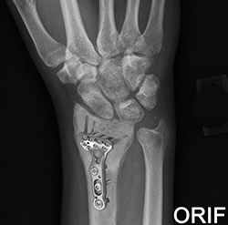 What is Open Reduction and Internal Fixation of the Wrist?