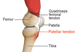 What is Osgood-Schlatter Disease