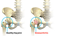 What is Osteoarthritis of the Hip