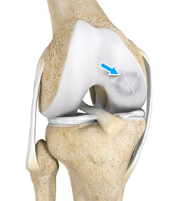 What is Osteochondritis Dissecans