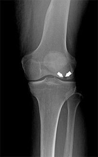 What is Osteonecrosis of the Knee