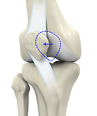 What is Patellofemoral Instability