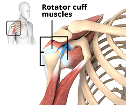 What is Rotator Cuff Tear?