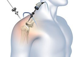 What is Shoulder Arthroscopy?