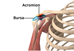 What is Shoulder Impingement