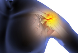 What is Shoulder Impingement?