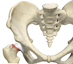 What is Slipped Capital Femoral Epiphysis