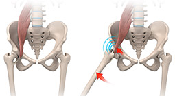 What is Snapping Hip Syndrome