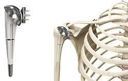 What is Total Shoulder Replacement?