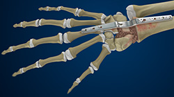 What is Total Wrist Arthrodesis?