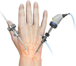 What is Wrist Arthroscopy?