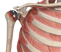 When is a Revision Shoulder Replacement Considered?