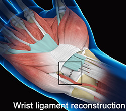 Wrist Ligament Reconstruction Procedure